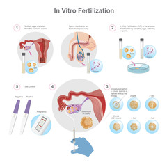 In vitro fertilization is a process of fertilisation where an egg is combined with sperm outside the body, in vitro (in glass). Health care education infographic. Vector design.