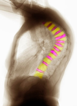 CT scan of thoracic spine with osteoporosis