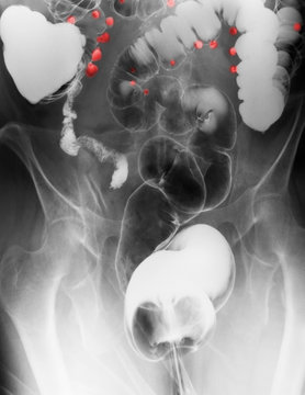 barium contrast X-ray, diverticulosis in the colon