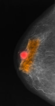 Mammogram with colloid carcinoma.