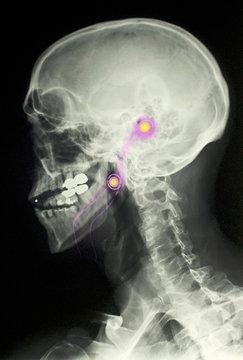 X-ray of the head of a man wearing iPod earphones