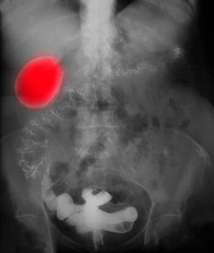 X-ray showing a so-called porcelain gallbladder