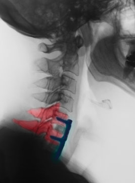 Cervical xray showing spinal fusion, C5, C6, C7