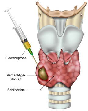 Feinnadelbiopsie der Schilddr&uuml;se