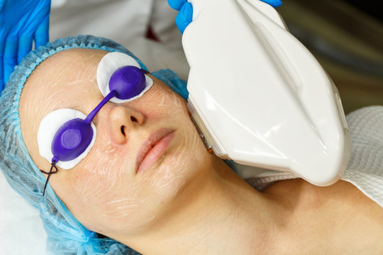 Laser RF-rejuvenation. Elos rejuvenation