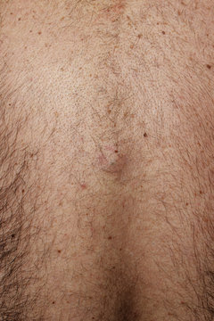 Epidermide pelosa