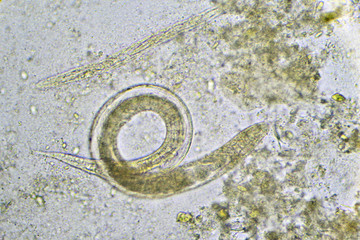 Strongyloides stercoralis (threadworm) in stool, analyze by microscope
