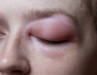 Young woman with allergic reaction on eye