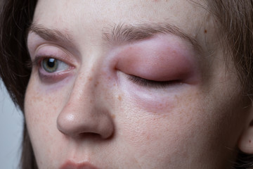 Young woman with allergic reaction - angioedema - obrazy, fototapety, plakaty