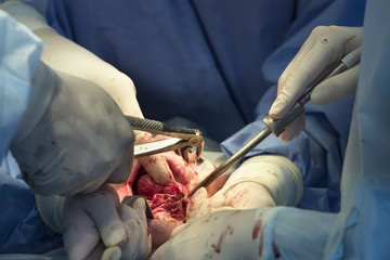 Surgeon pull out a tooth by forceps from a patients mouth during the maxillofacial surgery close up