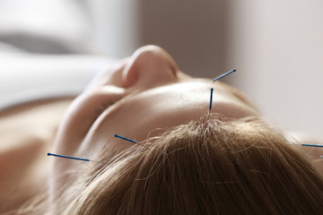 Young woman undergoing acupuncture treatment, closeup - obrazy, fototapety, plakaty