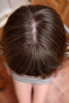 Gray hair in young girls, top view