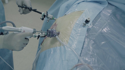 Laparoscopic surgery of the abdomen