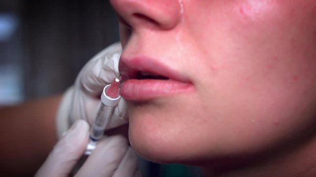 4K Close-up Doctor Applying Hyaluronic Acid Filler in Lips