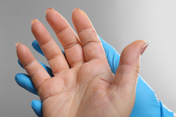 Doctor examining patient with dermatitis on hand, closeup