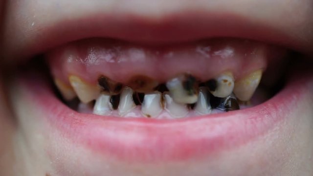 footage caries on the teeth of the child close up. 