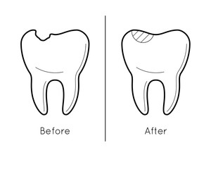 Icons of tooth before and after caries treatment in thin line style. Sick and healthy enamel of teeth. Dental problem. Vector outline simple illustrations isolated on white background.