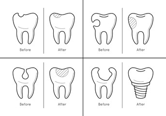 Icons of tooth before and after treatment, reconstruction or prosthetic in thin line style. Sick and healthy enamel of teeth. Dental problems. Vector outline simple illustrations isolated on white