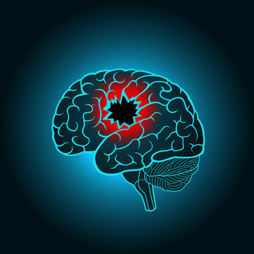 A brain with a hole, the concept of destruction of the brain, memory, stroke, injury