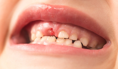 The mouth of a boy without a tooth
