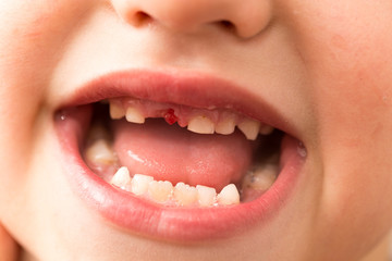 The mouth of a boy without a tooth