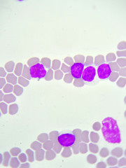 Leukemia cells in blood smear, analyze by microscope
