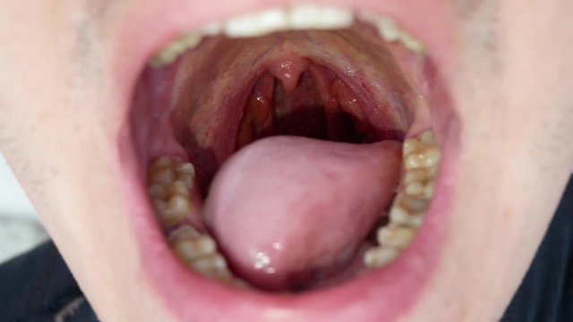 The Man Opens the Mouth and Shows the Throat with Tongue and Tonsils. Cavity Mouth and Teeth Smoker with Caries and Dental Stones. Temporary Seal on One Tooth