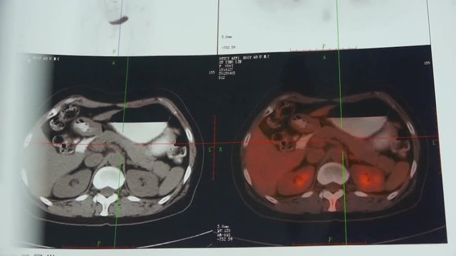 doctor study color stomach & pancreas pet-ct scan,human organ radiography.