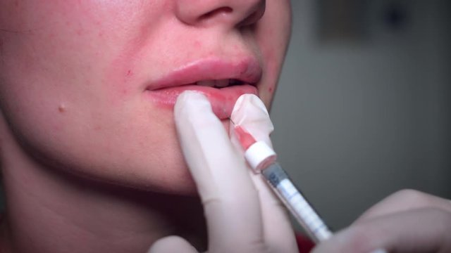 4K Close-up Woman Lips with Hyaluronic Acid Filler