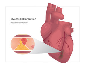  Myocardial infarction vector illustration. Cardiac infarct