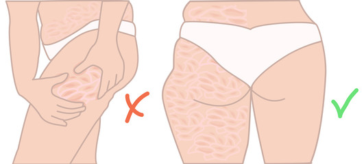 Cellulite before and after results. Transformation. Vector illustration