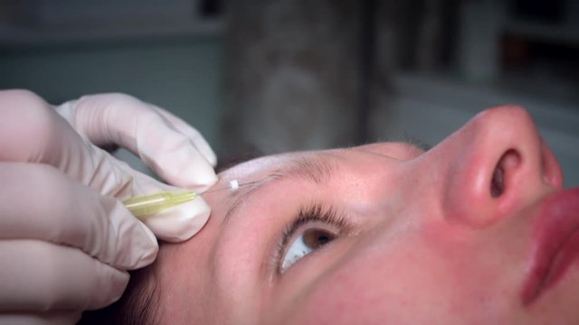 4K Doctor Applying PDO Thread Lifts in Woman Forehead