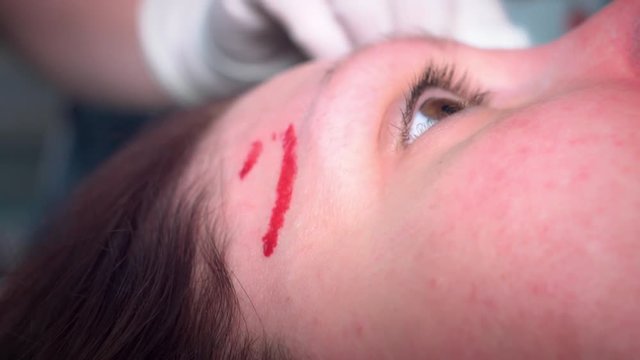 4K Woman Forehead Bleeding after PDO Thread Implants