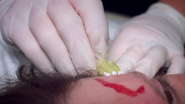 4K Doctor Applying PDO Thread Lifts in Woman Forehead
