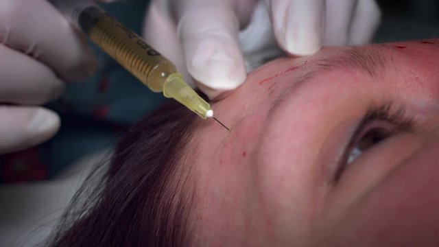 4K Doctor Applying Plasma PRP Lift Injection in Forehead