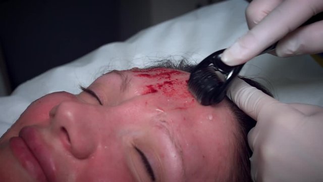 4K Doctor Doing Microneedling Procedure