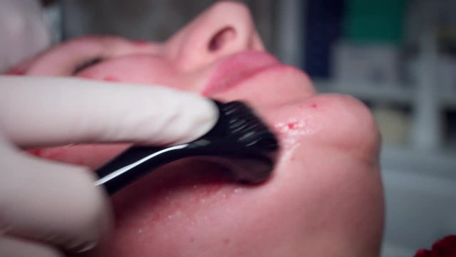 4K Doctor Doing Microneedling Procedure