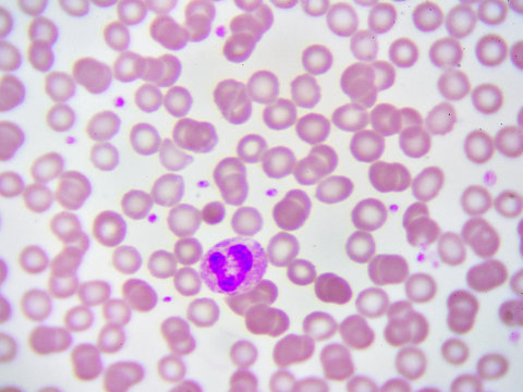 White blood cell in in blood smear, analyze by microscope