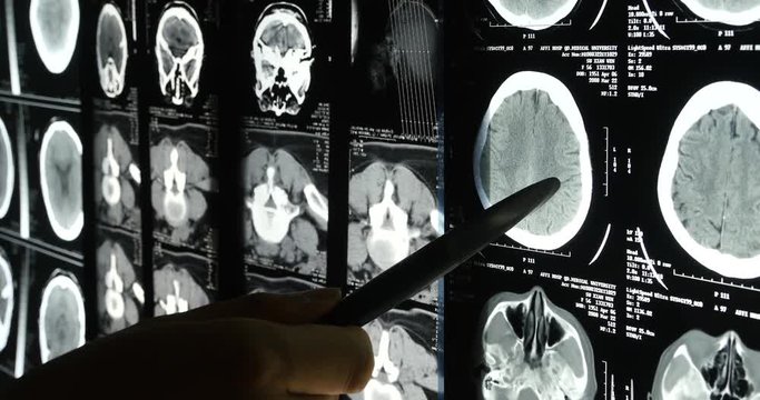 Doctors study head skull brain X-ray film for analysis.health medical hospital.