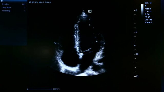 Colourful footage of homan heart ultrasound monitor