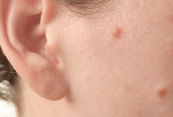 Young woman with problem skin, closeup