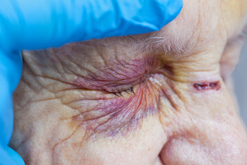Elderly woman's injured eye & nurse's fingers