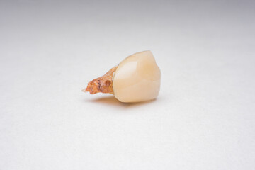 teeth, tooth, Caries, decayed tooth