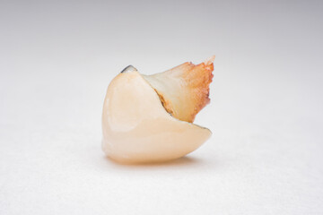 teeth, tooth, Caries, decayed tooth