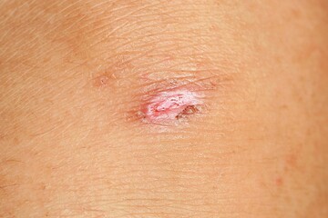 scar on the knee