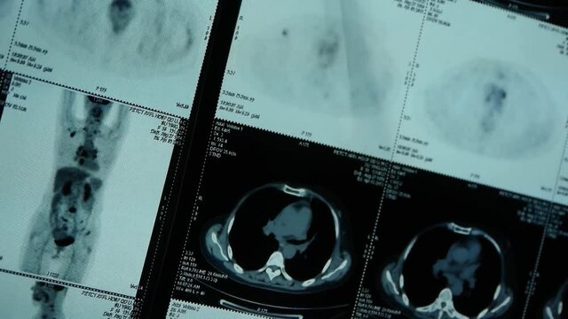 moving human orage pet-ct scan,medical X-ray,Cancer metastasis.