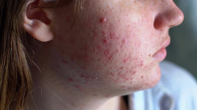 Face with acne problem, close-up