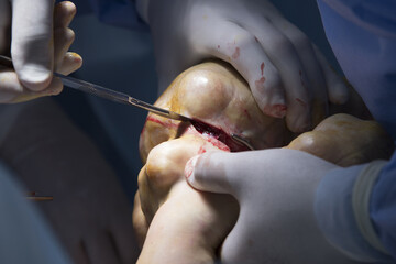 Surgical incision with a scalpel close up during the hand amputation surgery