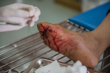 The wound stitched  in the foot by doctors in the hospital. Accidental wounds . - 157408937