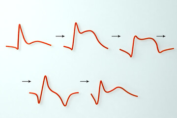 ECG in myocardial infarction. 3D illustration showing evolution of ECG with time